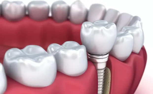 Implante-dentario1-e1783711778470
