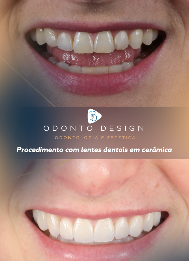 Procedimento-com-lentes